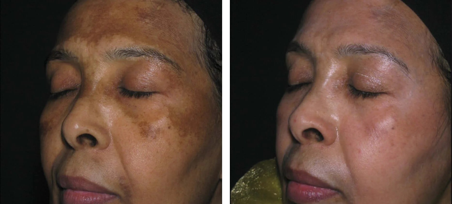 Hyperpigmentation Treatment in Dubai