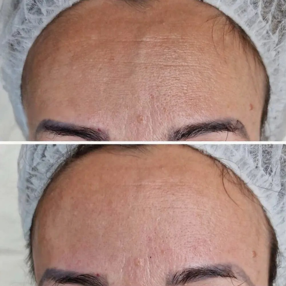 Best Carbon Peel Facial Results in Dubai