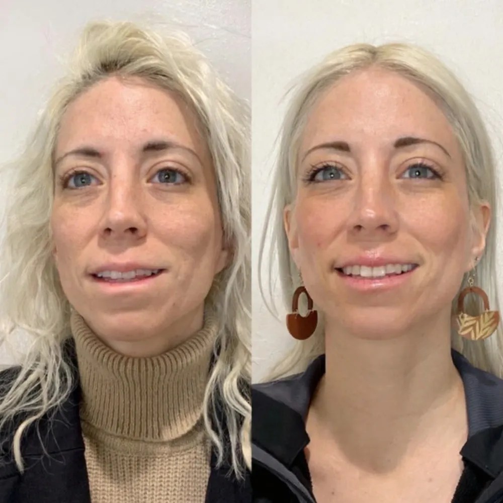 Best Dehydrated Skin Hydration Therapy in Dubai