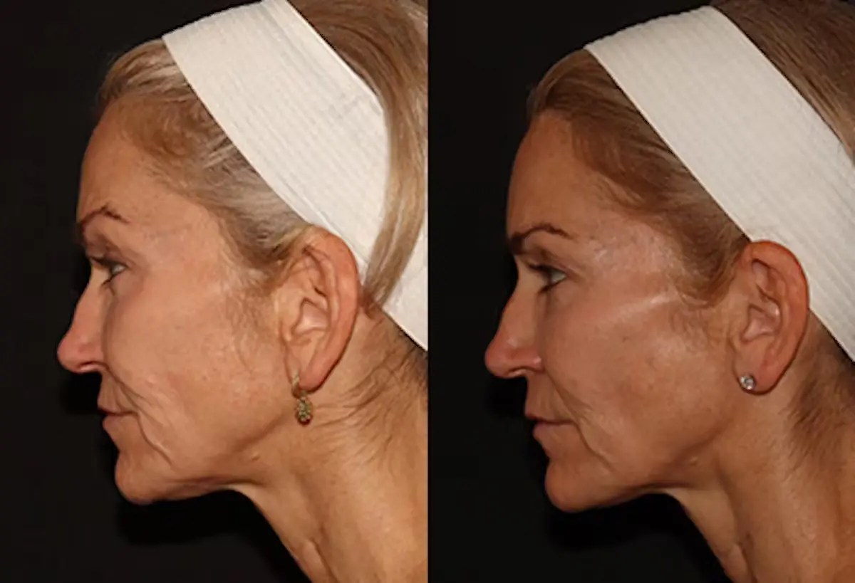Best Emface Non-Invasive Results in Dubai