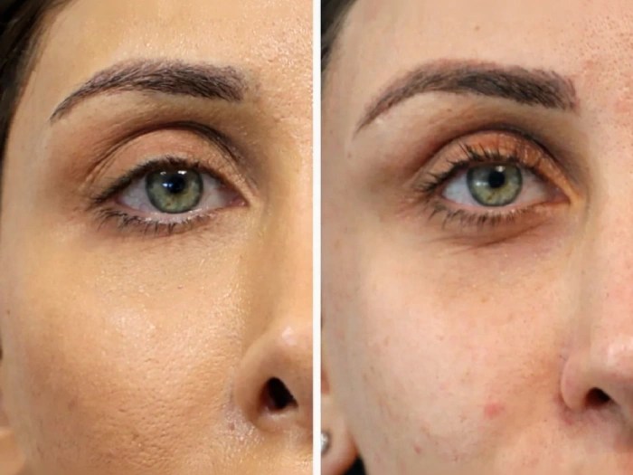 Best Filler Dissolving Treatment Results in Dubai