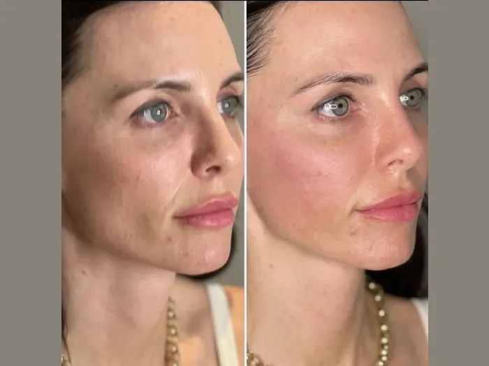 Perfect Drs Filorga NCTF Skin Booster