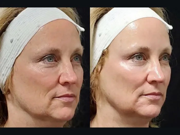 Best Red Carpet Facial Results in Dubai