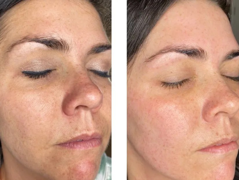 Best SaltFacial Results for Smooth Skin Dubai