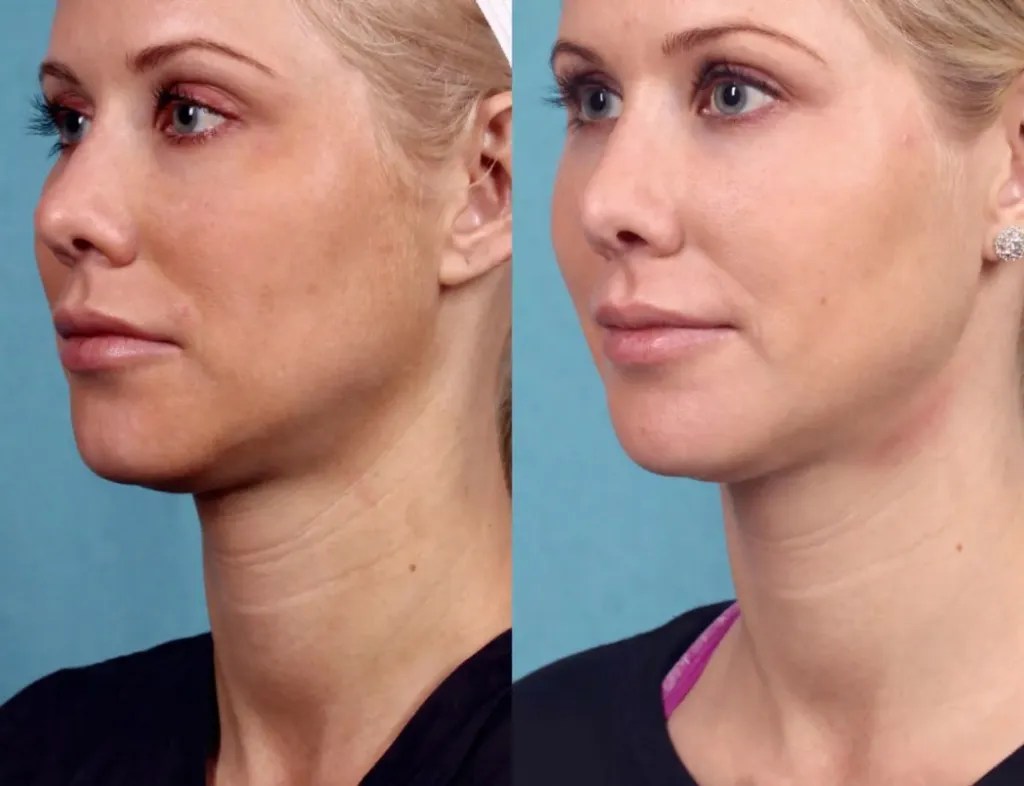 Best Ultherapy Lift Results in Dubai
