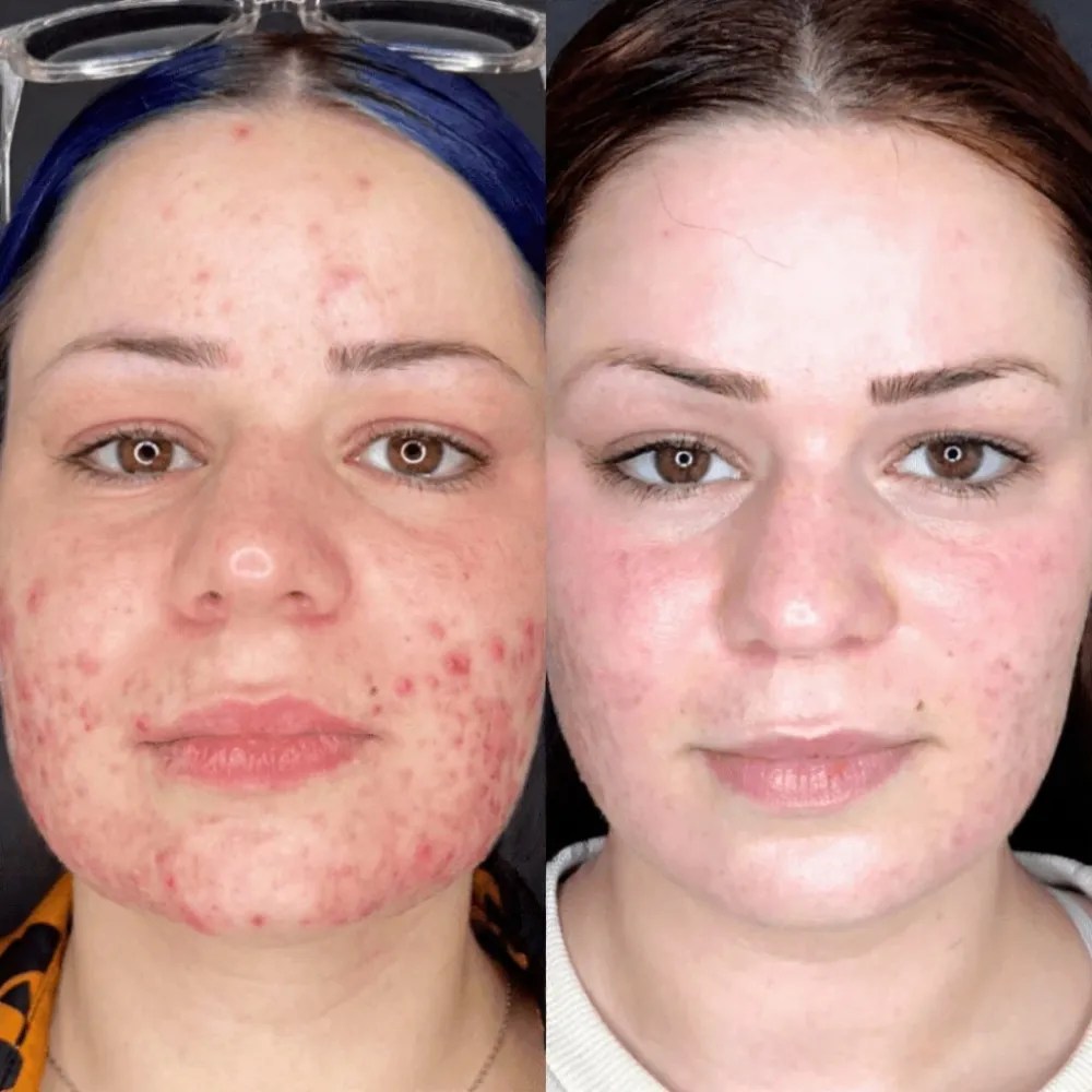 Skin Rejuvenation with Carbon Peel Facial at Perfect Drs