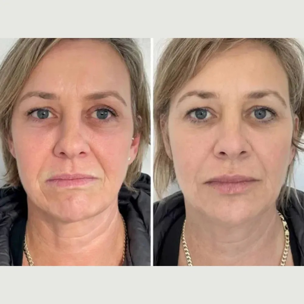 Perfect Drs Facial Treatment for Dehydrated Skin