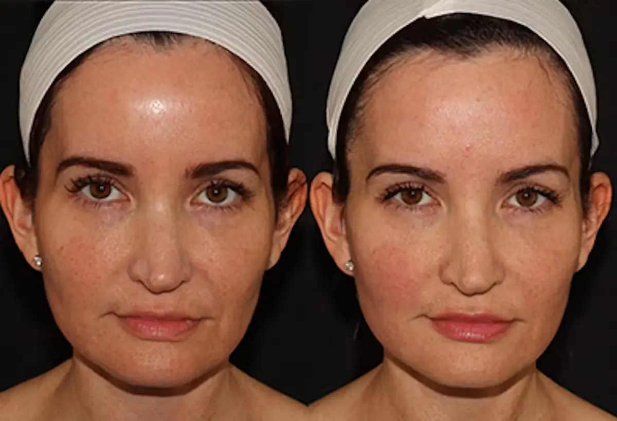 Emface Treatment for Non-Surgical Face Lift Dubai
