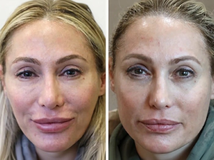 Perfect Drs Dissolving Fillers for Natural Look
