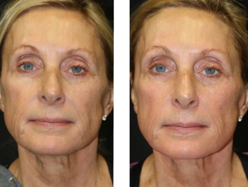 Perfect Drs SaltFacial Hydration Treatment
