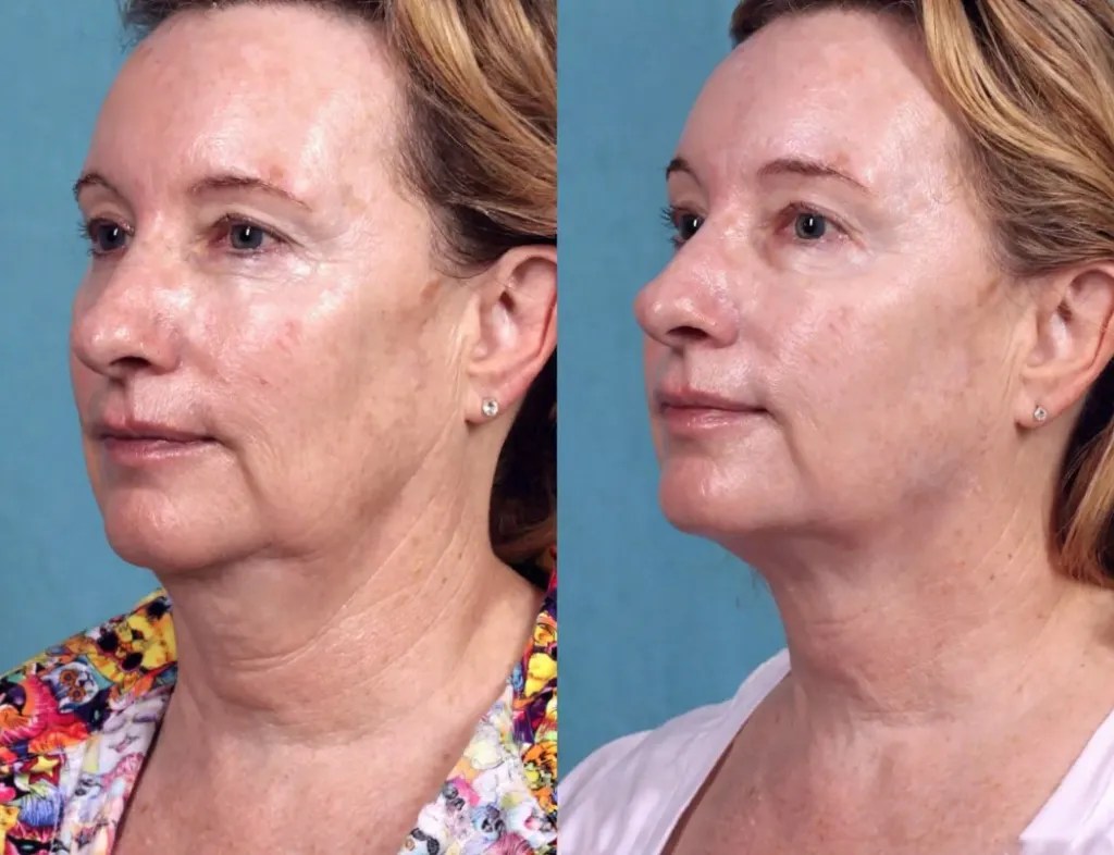 Perfect Drs Ultherapy for Skin Firmness