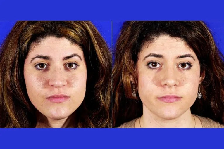 Perfect Drs Surgical Solution for Wide Nose