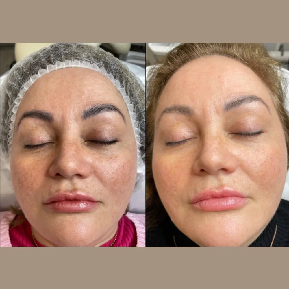 Carbon Peel Facial for Acne and Oily Skin Abu Dhabi