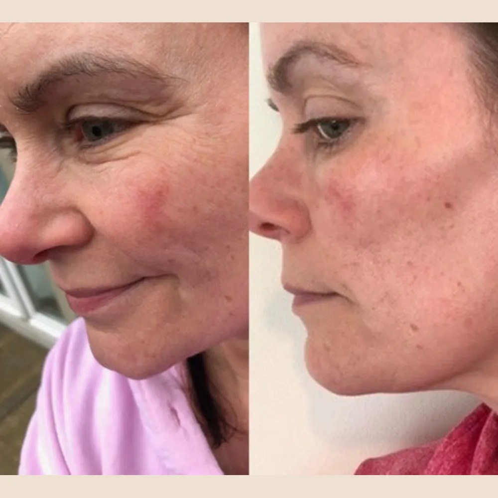 Skin Rejuvenation for Dehydrated Skin Abu Dhabi