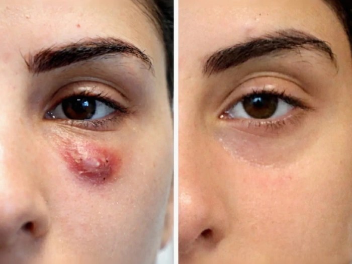 Fillers Dissolving for Lumps Correction Abu Dhabi