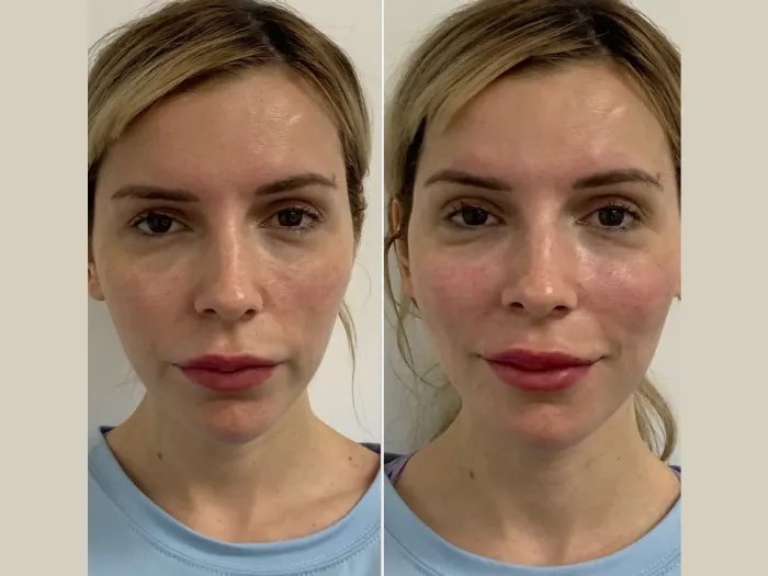 Filorga NCTF Treatment Dubai