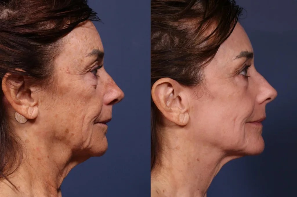Perfect Drs NCTF 135HA for Hydration and Glow