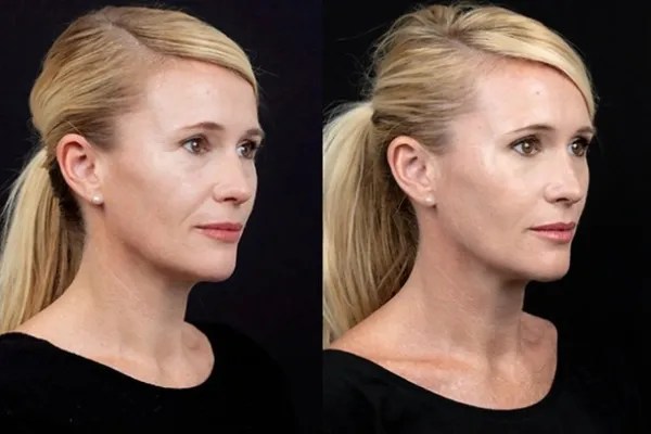 NCTF Treatment for Glowing Skin Abu Dhabi