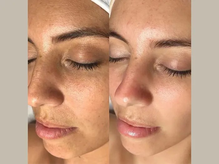 Red Carpet Facial for Skin Brightening Abu Dhabi