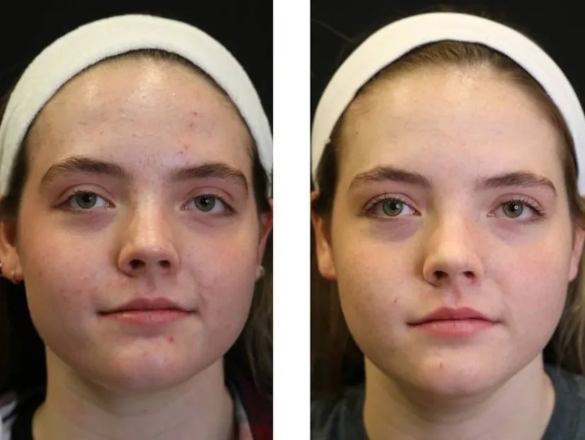SaltFacial Deep Cleansing Procedure Abu Dhabi