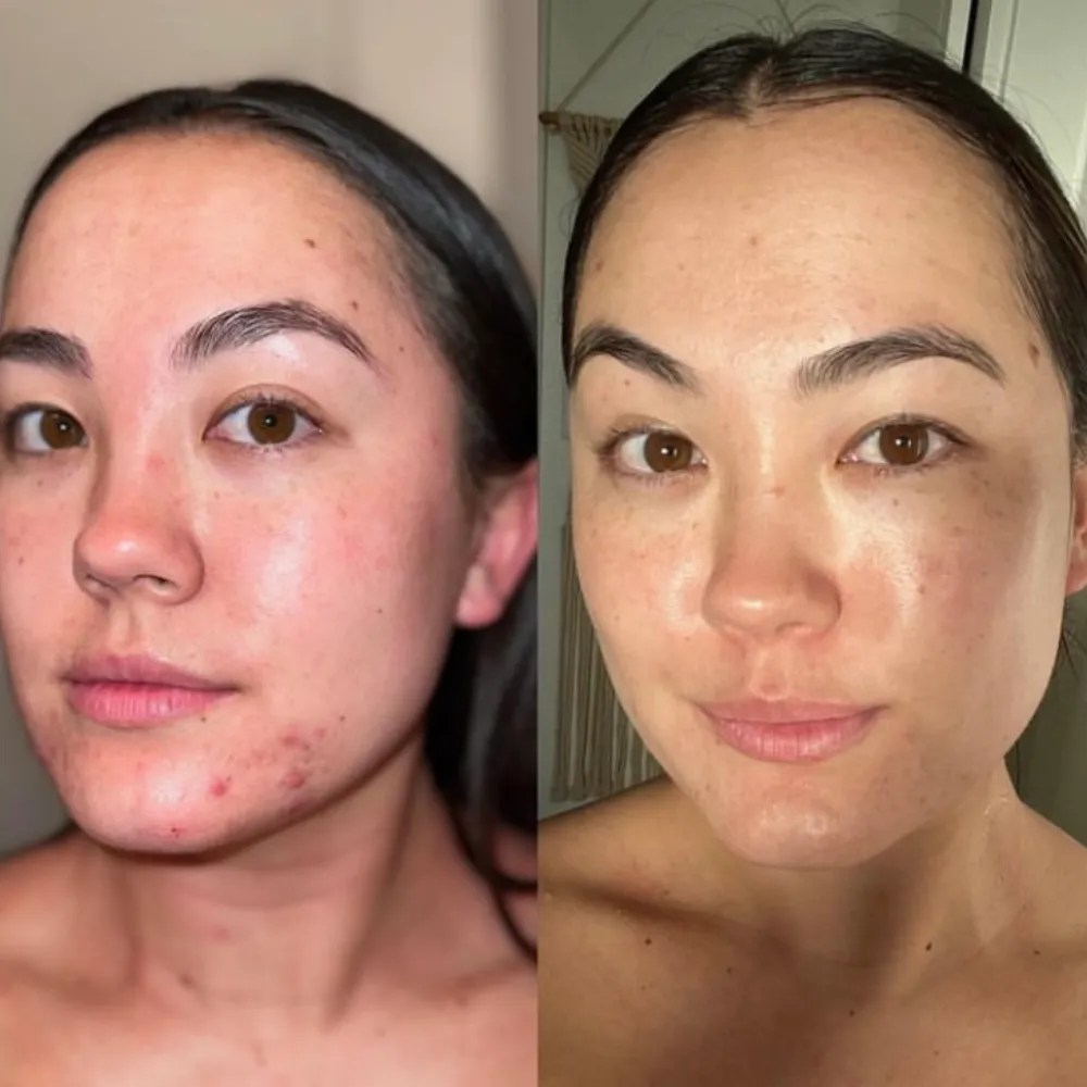 Safe Carbon Peel Facial Therapy in Dubai