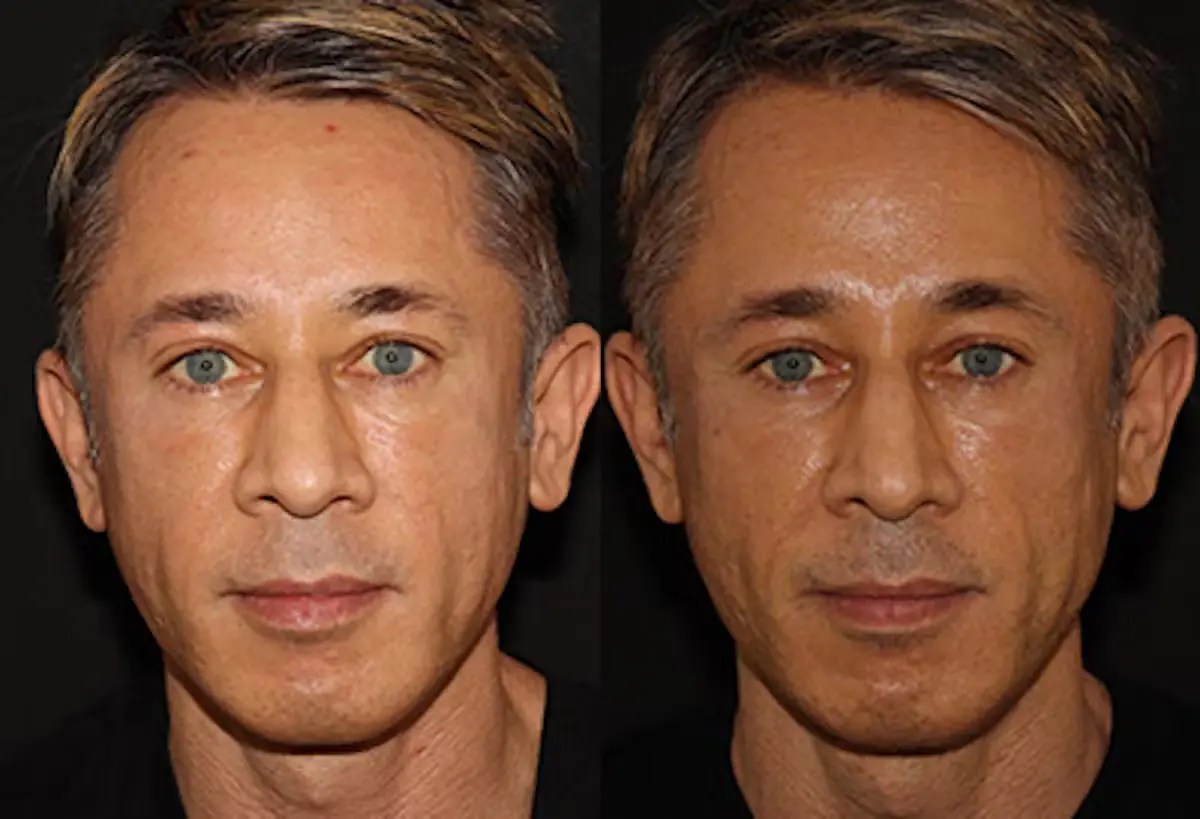Perfect Drs Emface for Skin Tightening