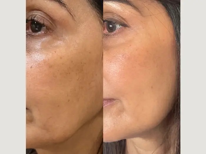 Safe Filorga NCTF Treatment for Anti-Aging Dubai