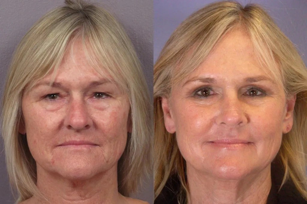 Safe NCTF 135HA Anti-Aging Therapy Dubai