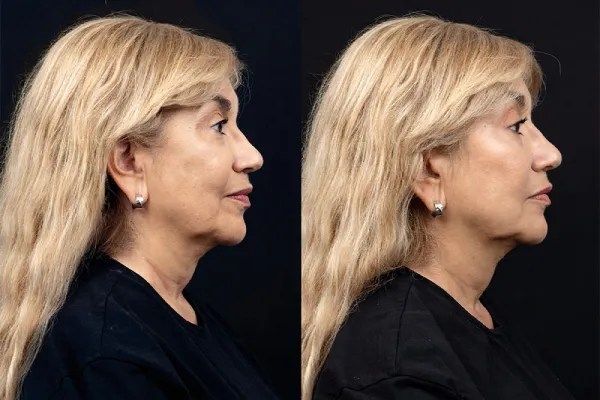 Safe NCTF Skin Revitalization in Dubai