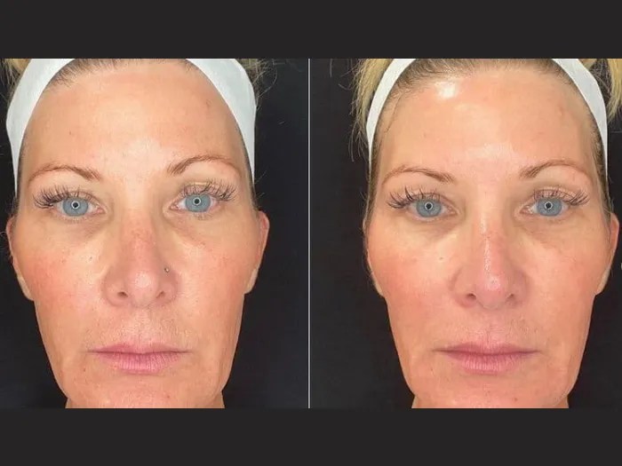 Safe Red Carpet Facial for Events Dubai