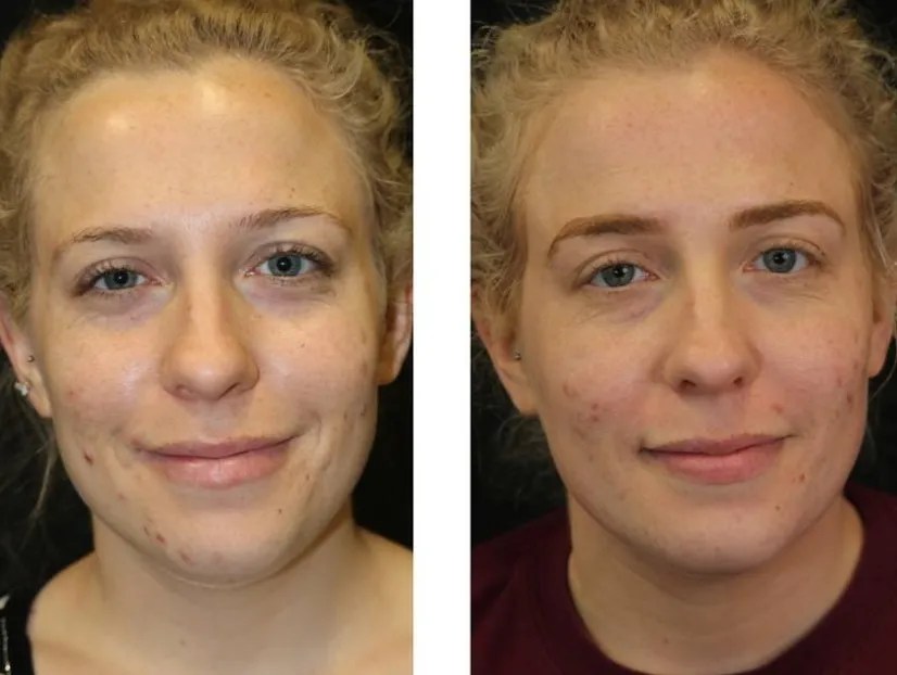 Safe SaltFacial for Skin Rejuvenation Dubai