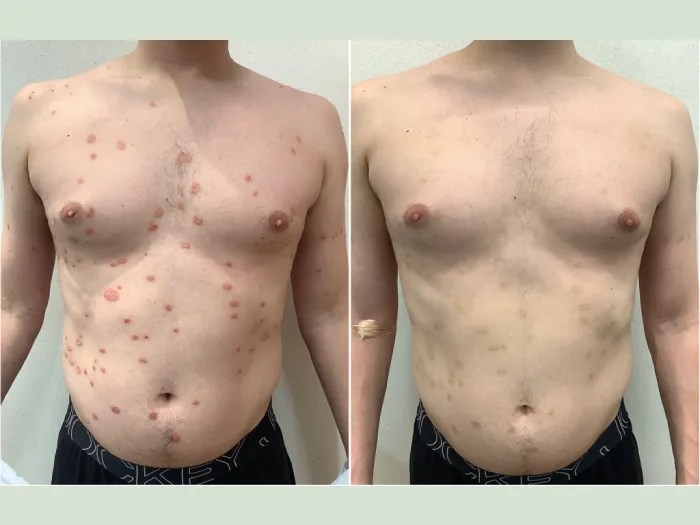 Perfect Drs Dermatology for Rash Relief