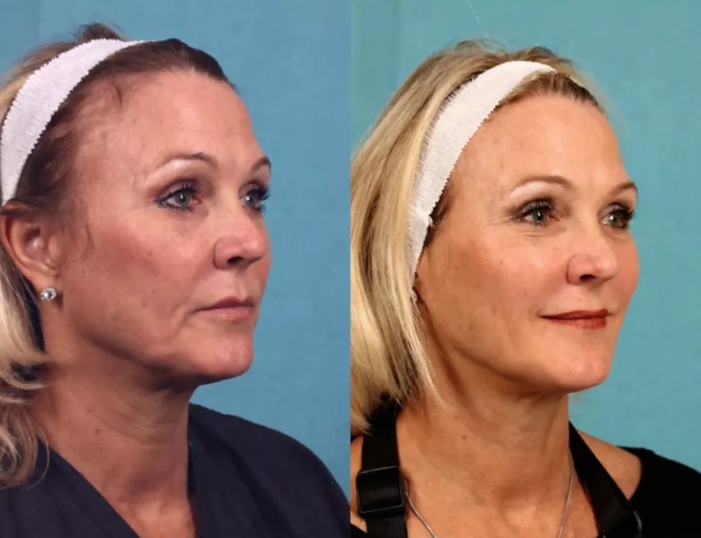 Safe Ultherapy Wrinkle Reduction Dubai