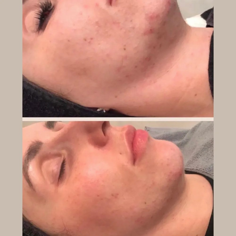 Perfect Drs Carbon Peel Facial for Glowing Skin