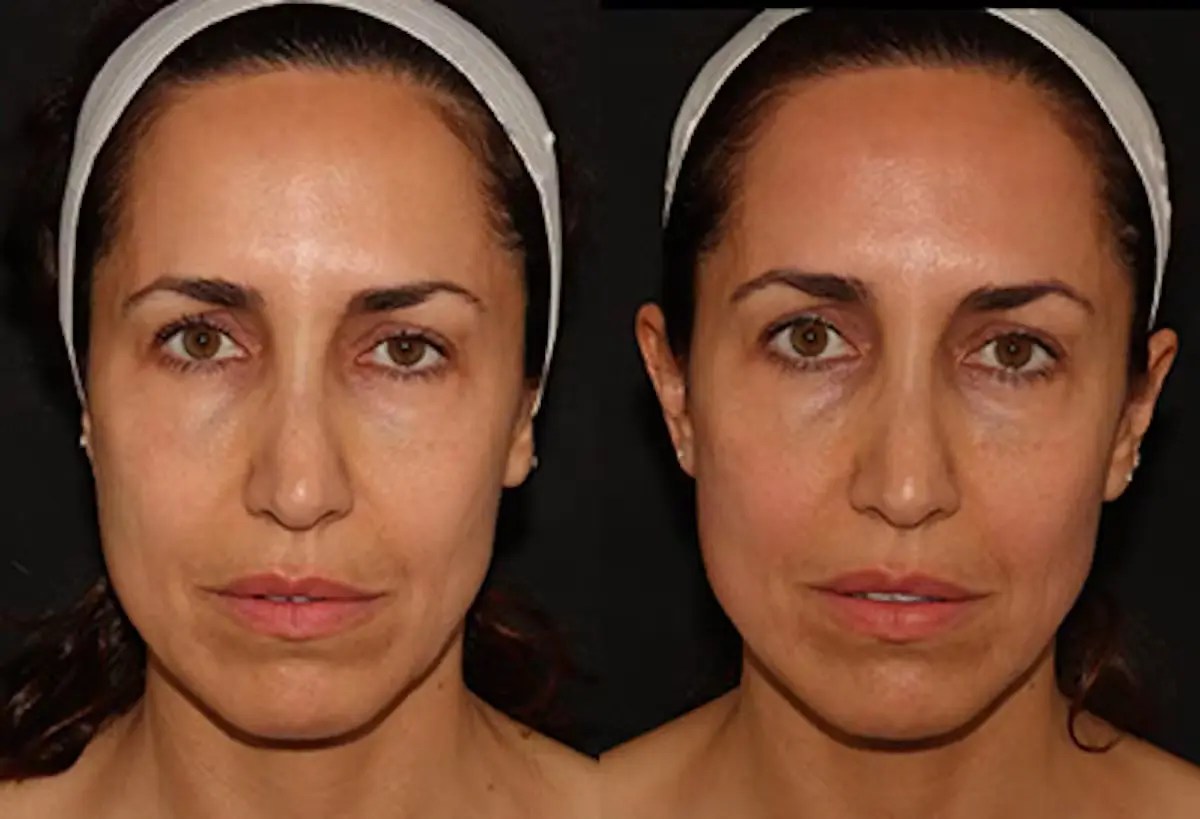 Safe Emface Procedure for Facial Contouring Dubai