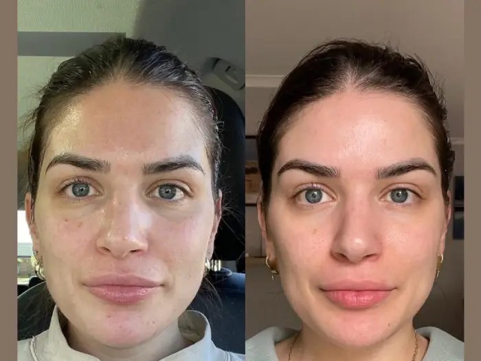 Filorga NCTF Skin Rejuvenation Abu Dhabi