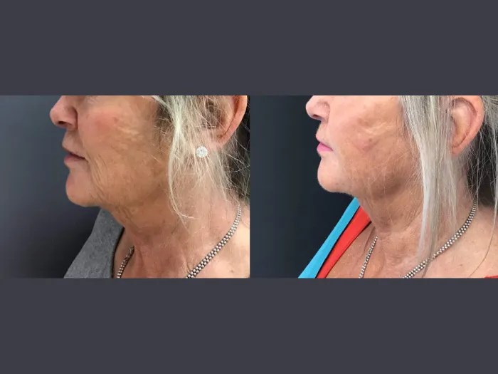 Wrinkle Reduction with Liftera Hifu Abu Dhabi