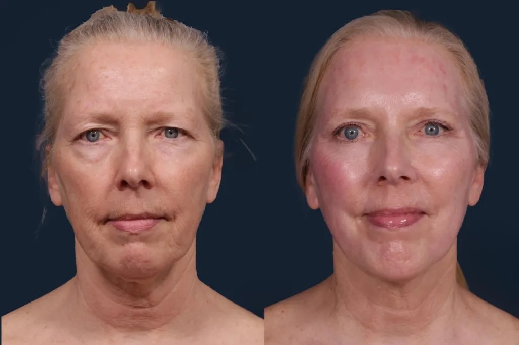 NCTF 135HA for Skin Revitalization Abu Dhabi