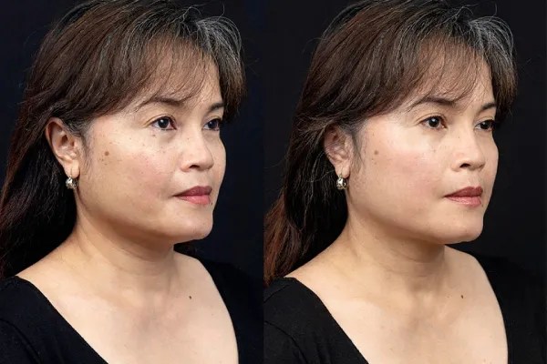 Perfect Drs NCTF Treatment for Anti-Aging
