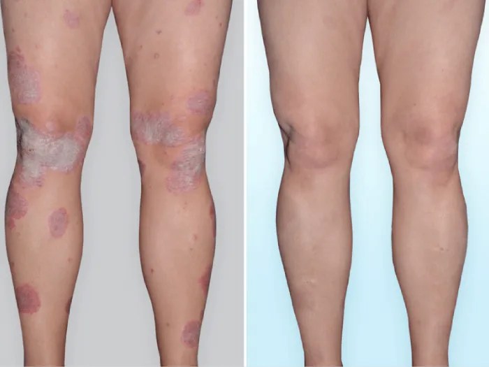 Skin Rash Treatment in Dubai