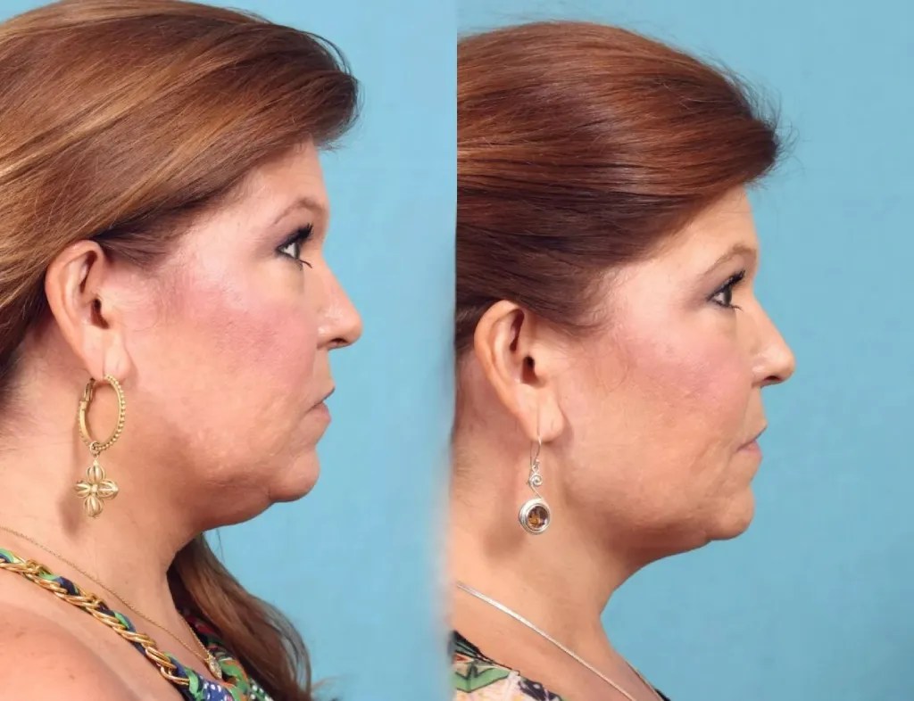 Perfect Drs Ultherapy for Jawline Lift