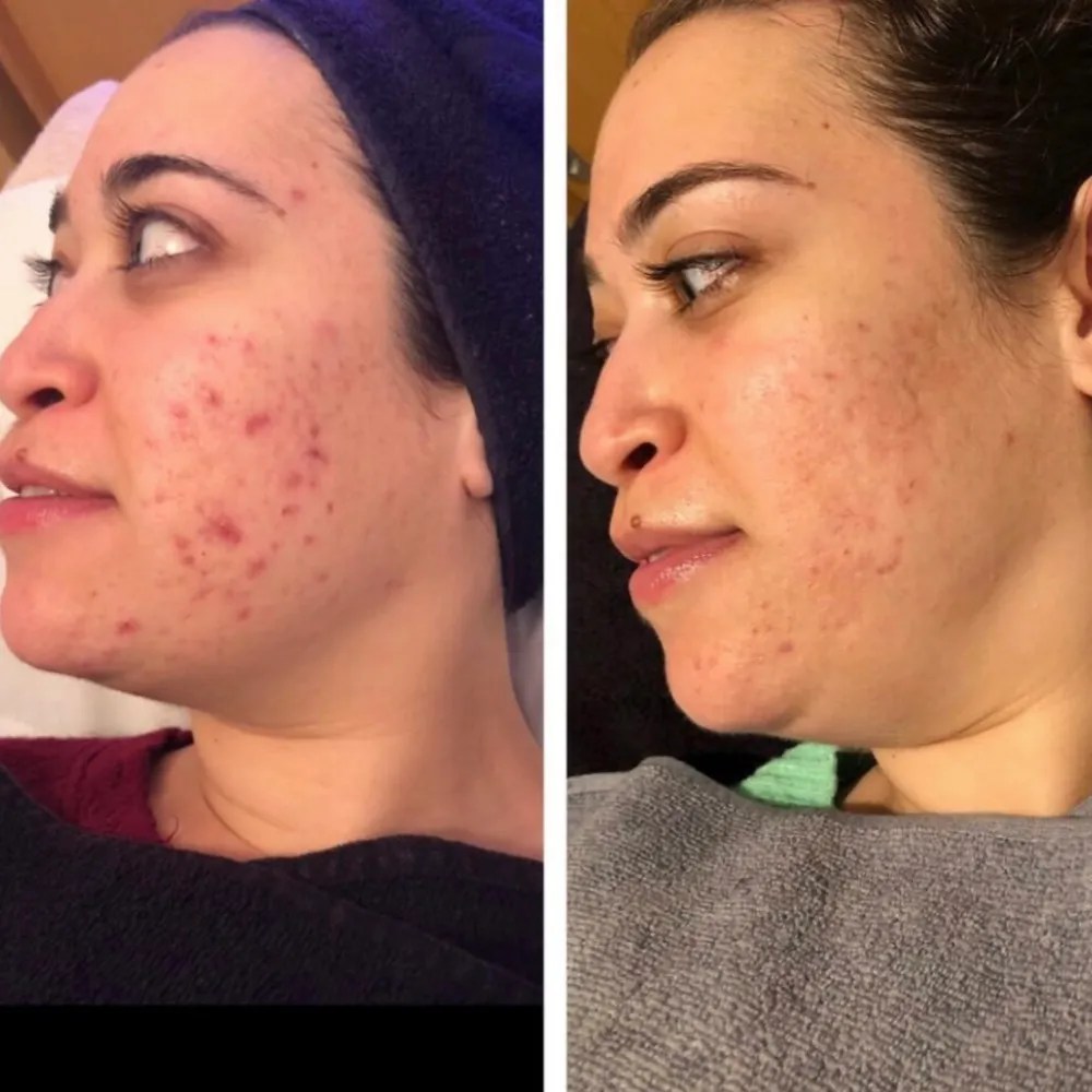 Advanced Carbon Peel Facial Abu Dhabi