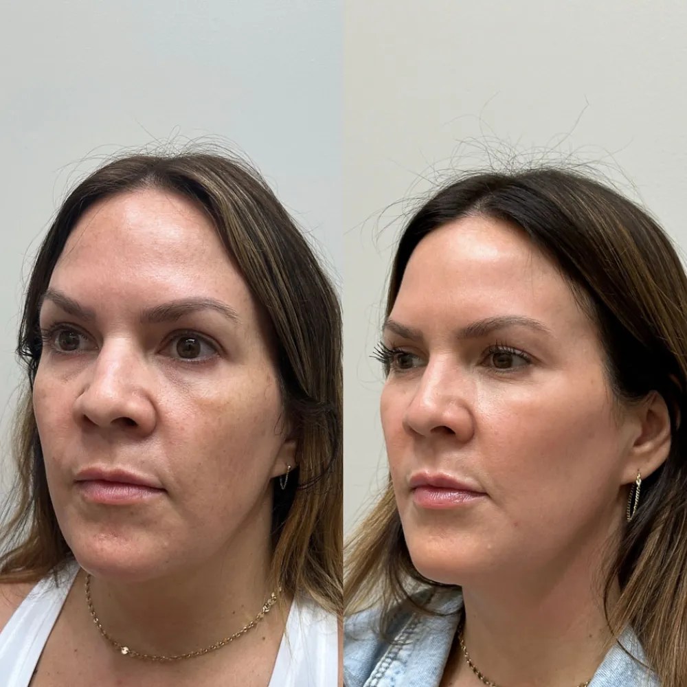 Advanced Dehydrated Skin Therapy Abu Dhabi