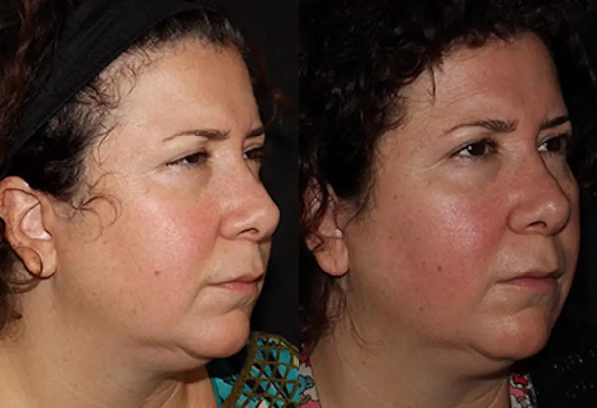 Emface Wrinkle Reduction Treatment Abu Dhabi