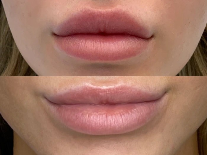 Advanced Filler Dissolving Injections Abu Dhabi