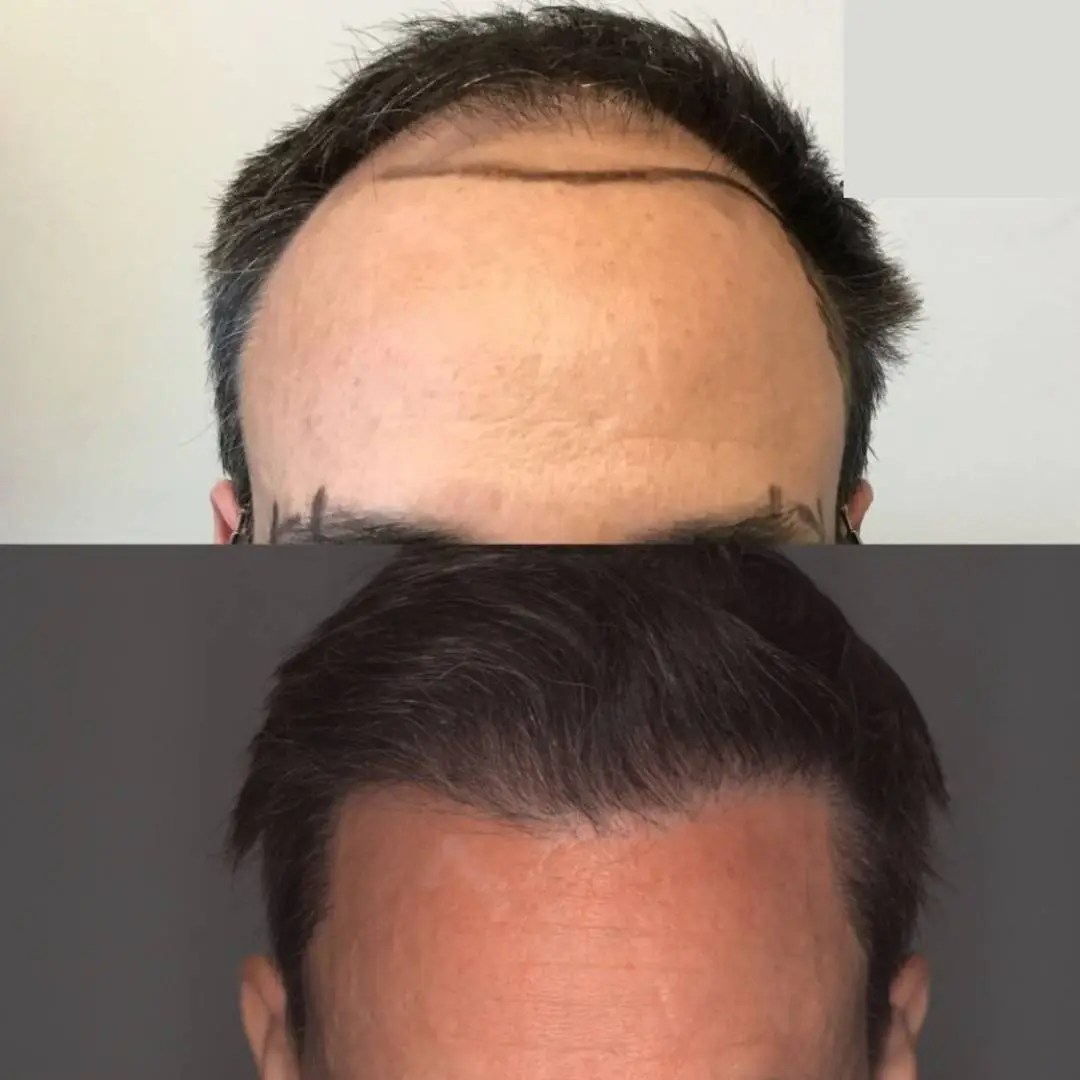 Perfect drs non-surgical hair restoration