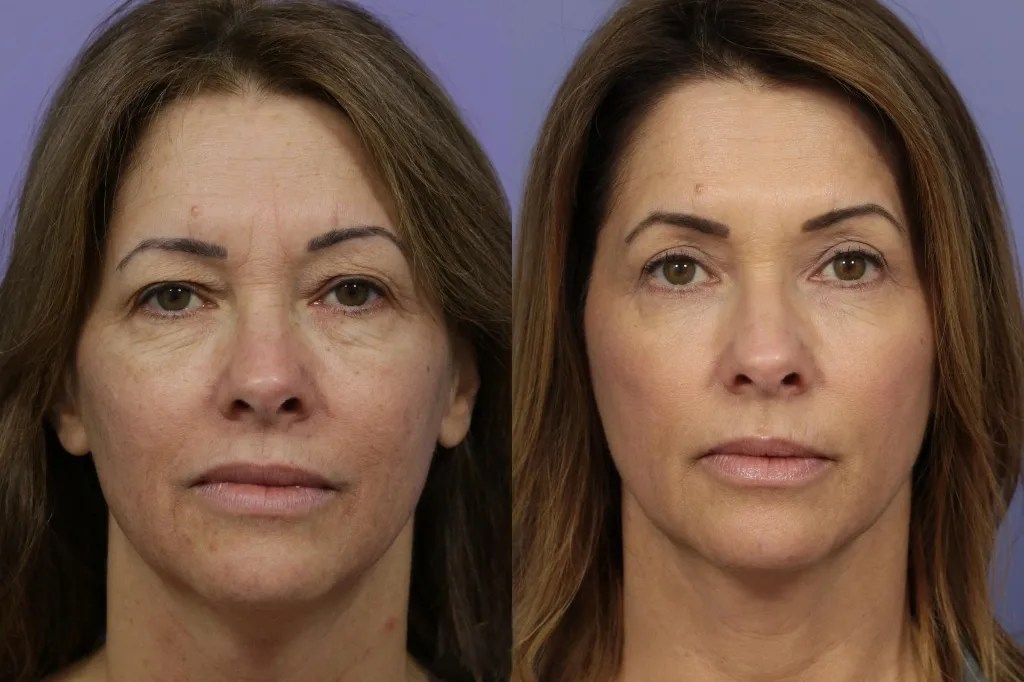 Perfect Drs NCTF 135HA Mesotherapy