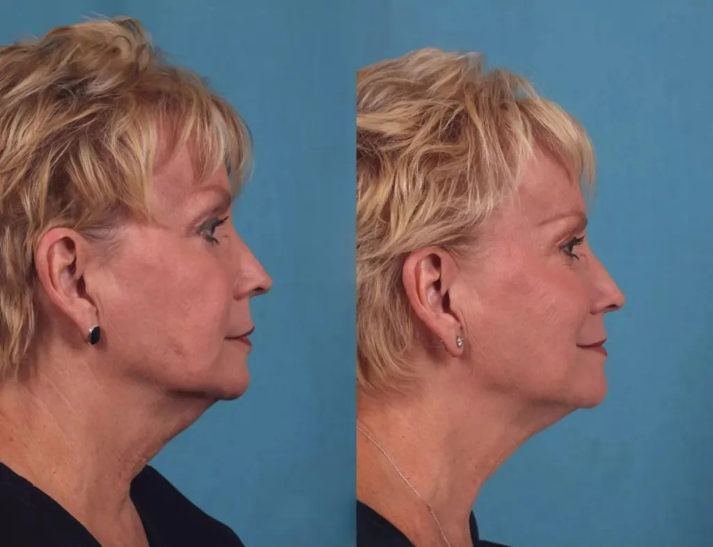 Advanced Ultherapy Skin Tightening Abu Dhabi