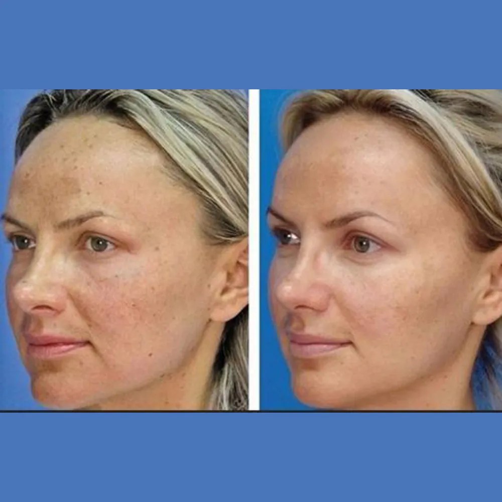 Carbon Peel Facial Treatment in Dubai