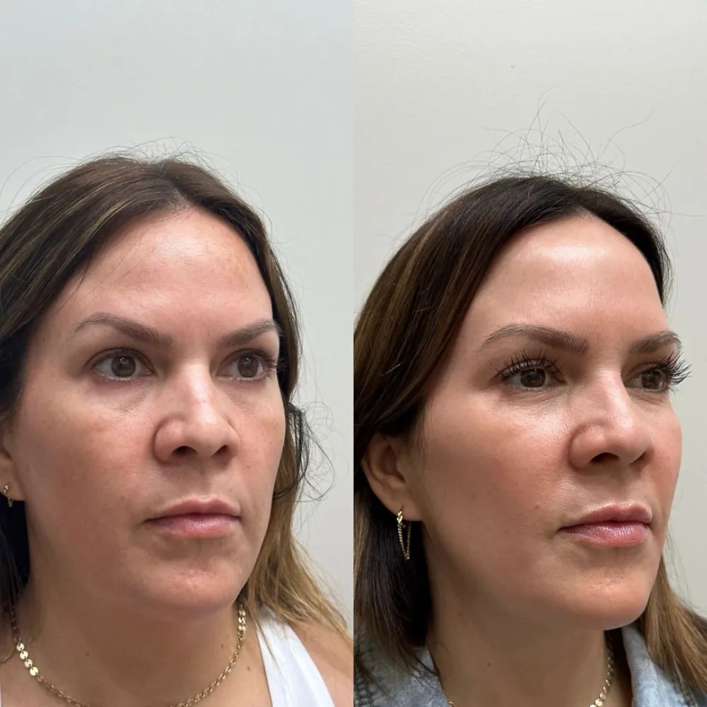 Dehydrated Skin Treatment in Dubai